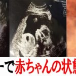胎児エコー写真で赤ちゃんと母親の健康状態が分かるぞ