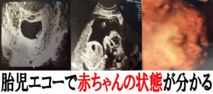 胎児エコー写真で赤ちゃんと母親の健康状態が分かるぞ