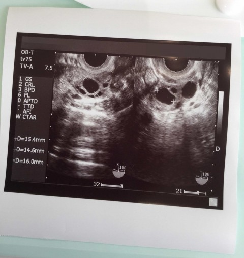 多事エコー検査