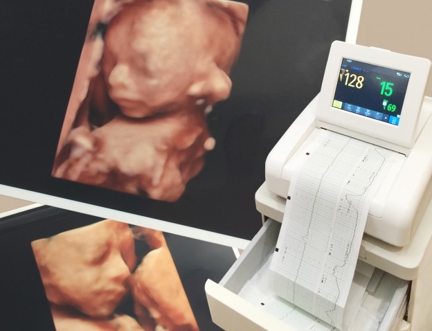 胎児エコーの安全性