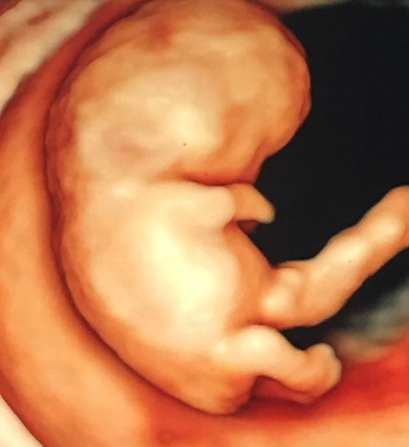 妊娠で増える体重