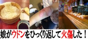 釜揚げウドンで火傷した娘!幼児は目を離してはいけない