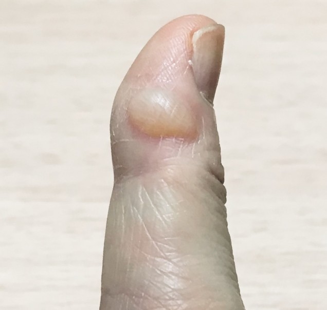 火傷で出来たケロイド